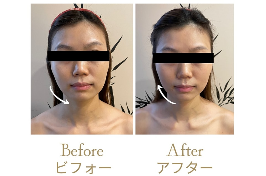 Pictures before and after the small face care treatment