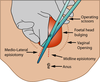 Episiotomy - Wikipedia