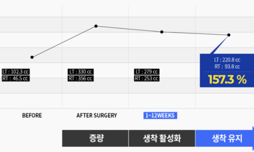 가슴줄기세포, 어떤 환자도 77.48%생착률 가능하다? <최초공개>