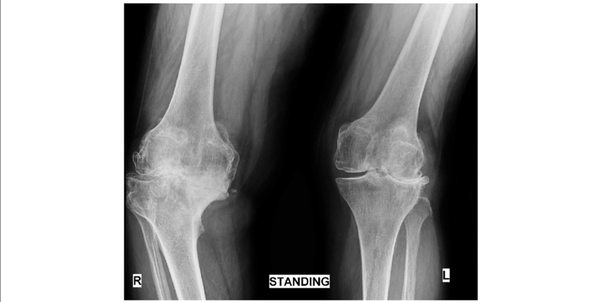 knee-rheumatoid-arthritis