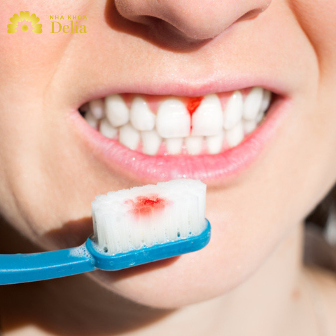 Nguyên nhân do viêm nướu dẫn đến chảy máu chân răng 