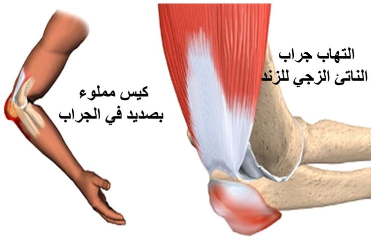 E:\Documents and Settings\USER\Desktop\كبار السن\التهاب الجراب الزندي.jpg