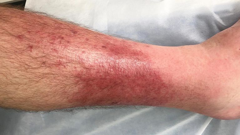 Skin-Conditions-You-Should-Know-About-12-Cellulitis-1440x810