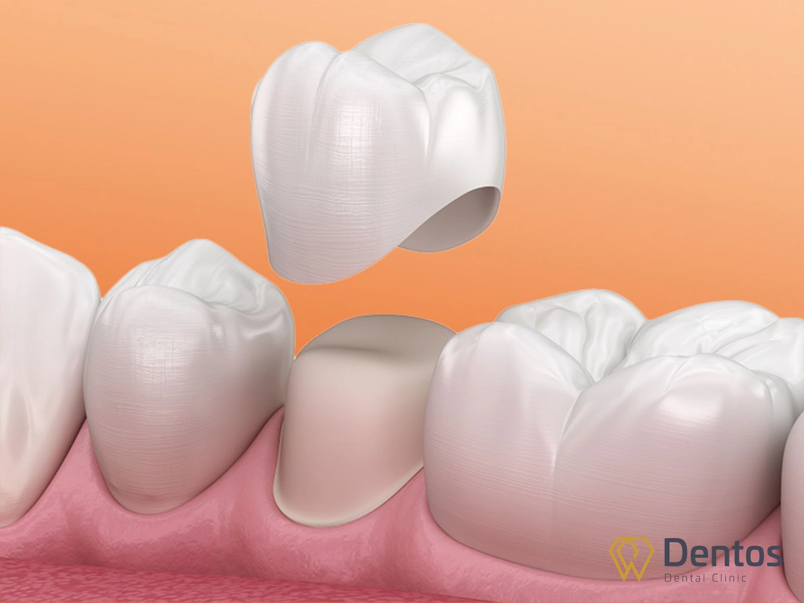 Hiểu về bọc răng sứ - Quy trình bọc răng sứ mất bao lâu?