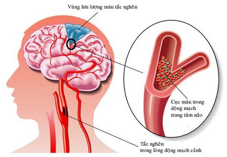 Nguyên nhân gây đột quỵ