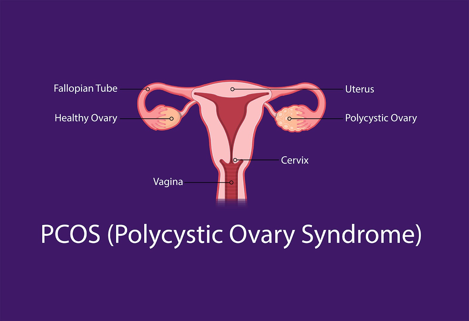 All you need to know about Polycystic Ovary Syndrome (PCOS)