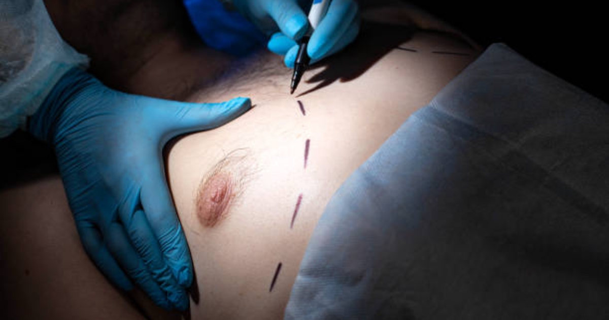 Can Liposuction Get Rid Of Gynecomastia Liposuction