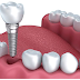 Trồng Răng Implant: Sự Thay Thế Hoàn Hảo Cho Hàm Tháo Lắp