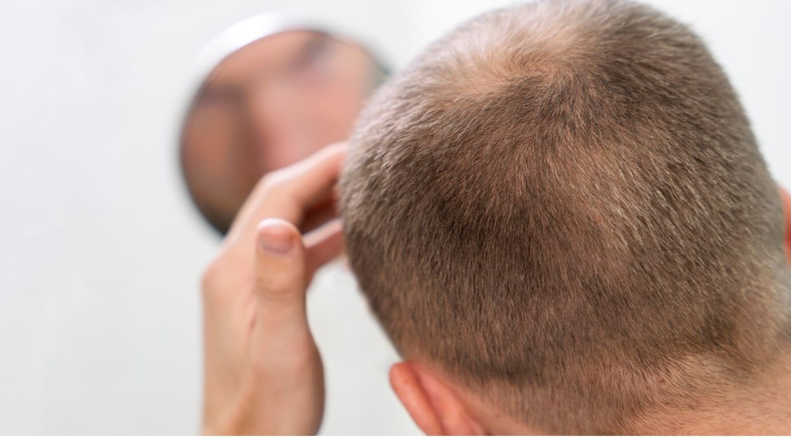 Common Causes of Hair Loss