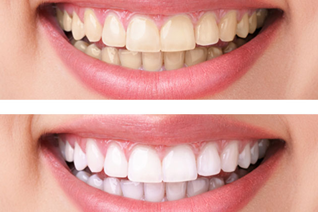 teeth whitening services in Richmond Hill 