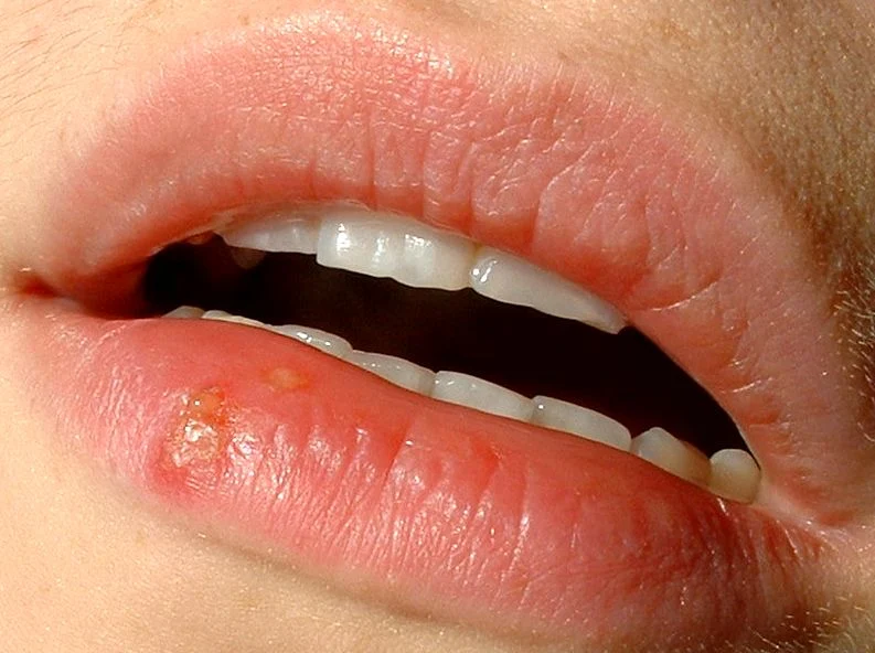 Archivo:Herpes labialis.jpg