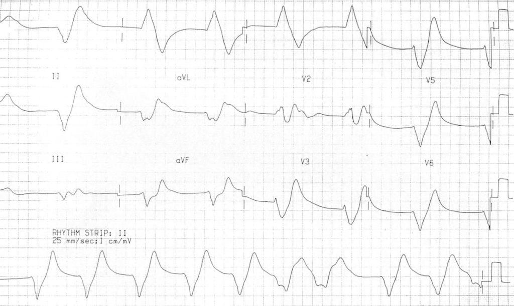 ECG Hyperkalemia sine wave serum potassium 9.9