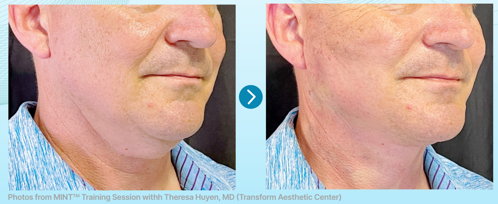 male neck before and after using MInt PDO Thread Lift