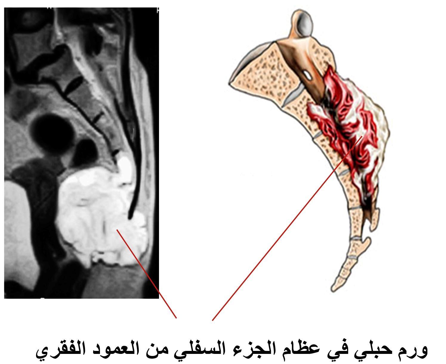 E:\Documents and Settings\USER\Desktop\Shared Files\bone cancer\الحبلي.jpg