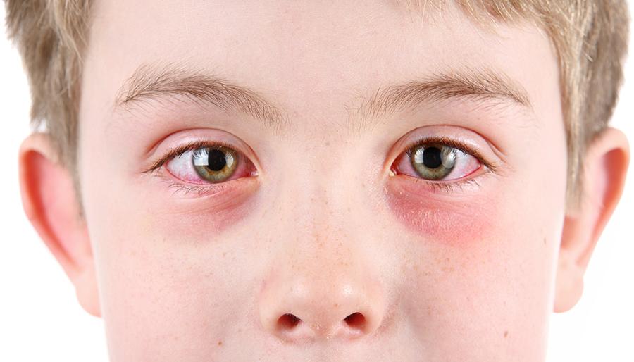 Everything parents ever wanted to know about pink eye | Children's Wisconsin
