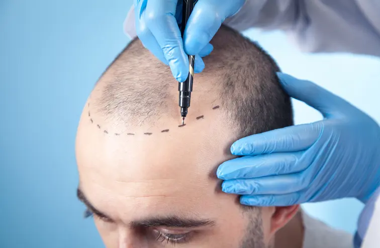 Điều trị rụng tóc bằng tế bào gốc như thế nào?