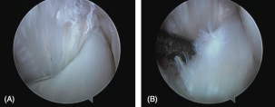 Obrázek 13: A) artroskopické zobrazení LCC bez zjevného potrhání vazu, B) paciální ruptura LCC