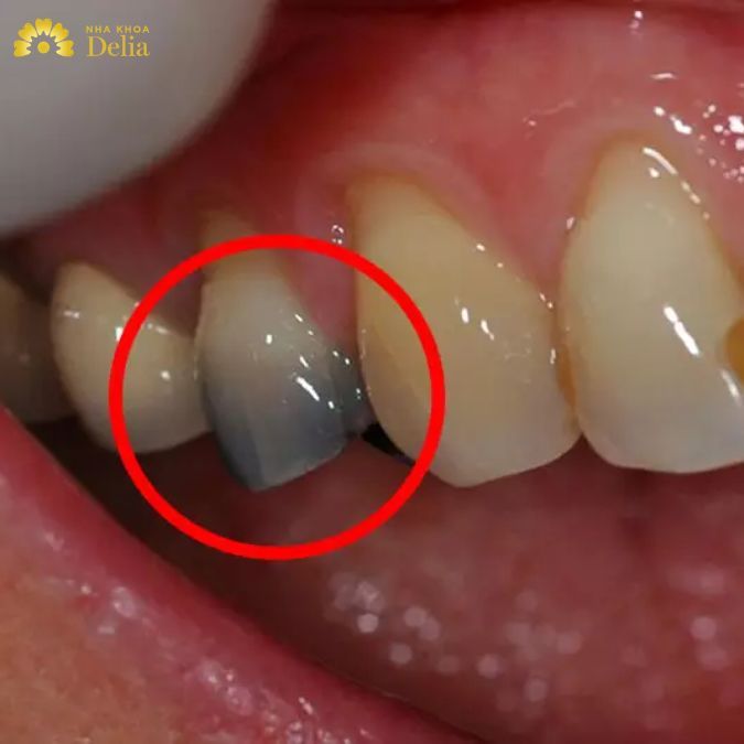 Vệ sinh răng miệng sai cách cũng khiến chân răng dần đổi màu