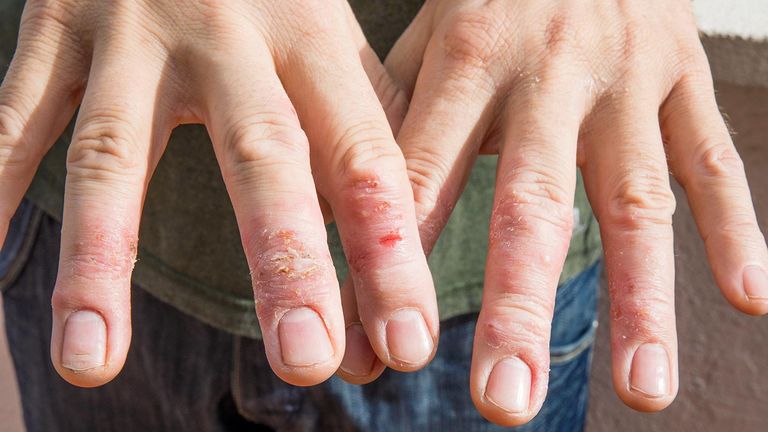 Skin-Conditions-You-Should-Know-About-03-Eczema-1440x810