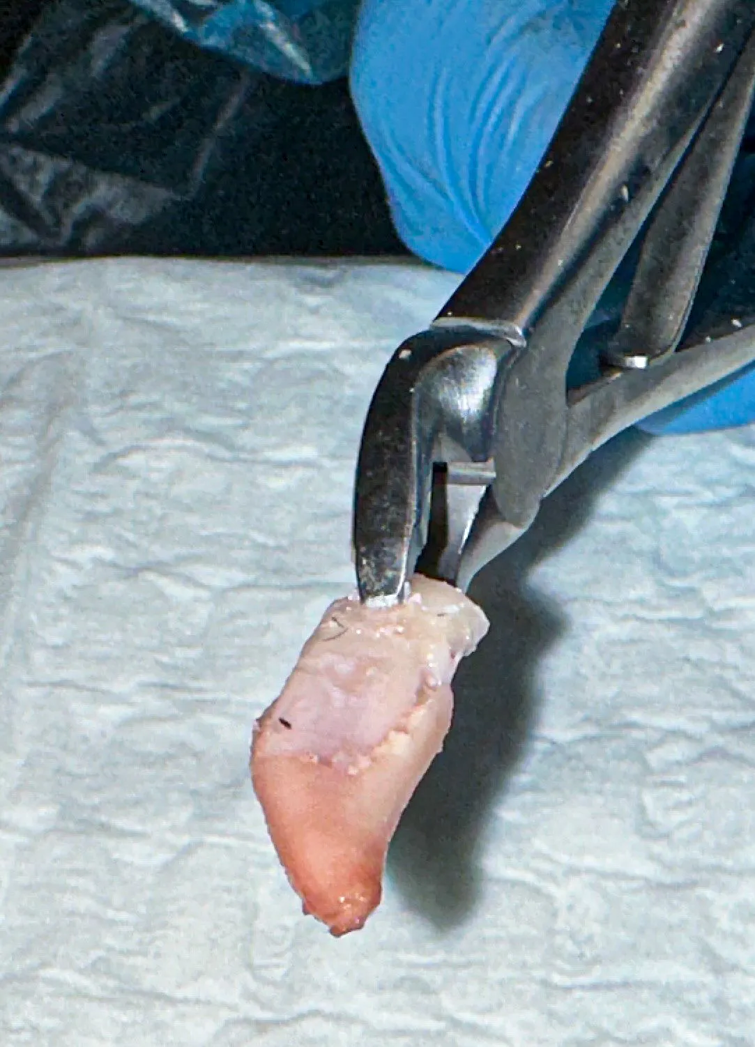 Figure 6: Delivery of the maxillary canine root is shown
