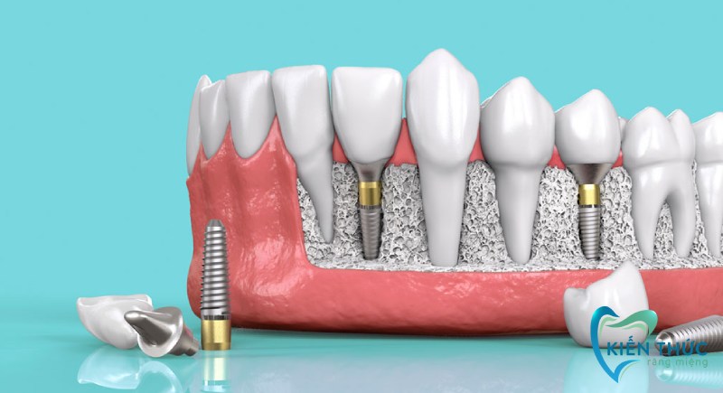 Trồng răng implant giá bao nhiêu 1 cái