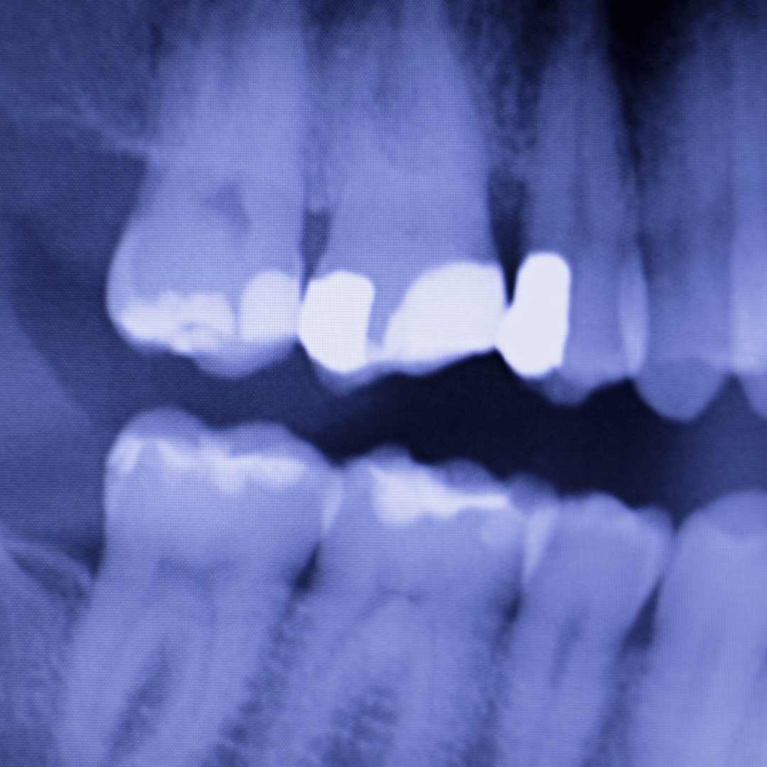 Can You Smoke After a Dental Filling