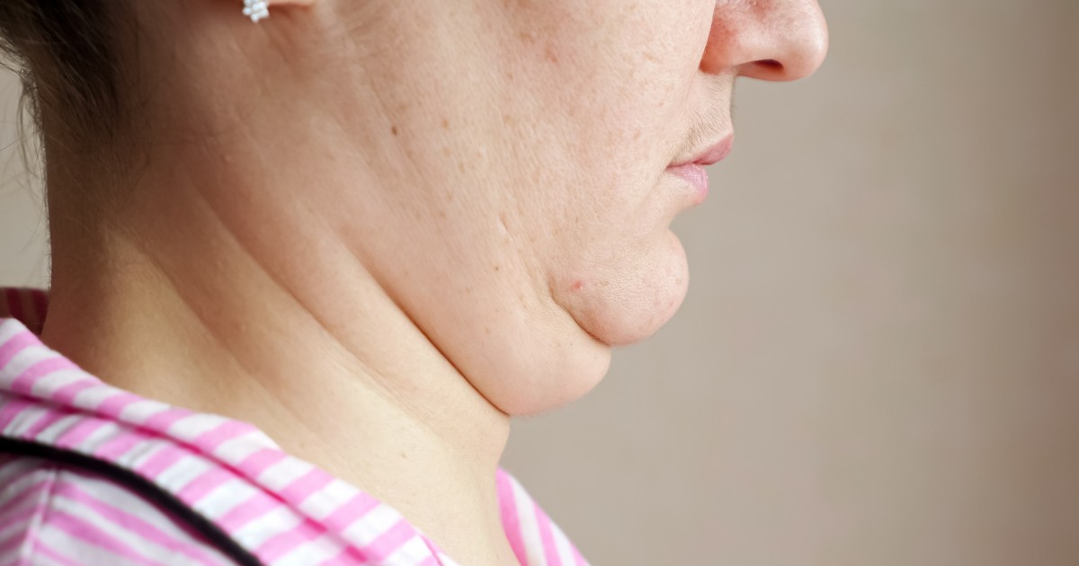 Liposuction Chin Before And After Liposuction