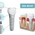 Cấy Ghép Implant: Giải Pháp Phục Hồi Răng Mất Lý Tưởng