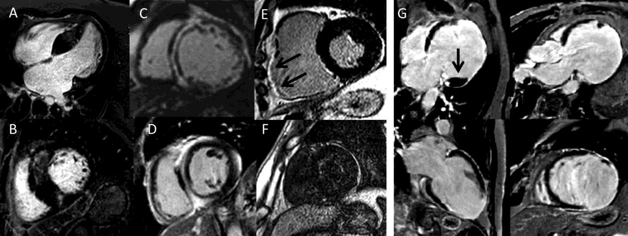 Cardiovascular magnetic resonance imaging: what the general cardiologist  should know | Heart