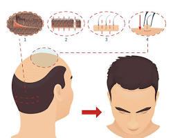 Image of FUT hair transplant procedure