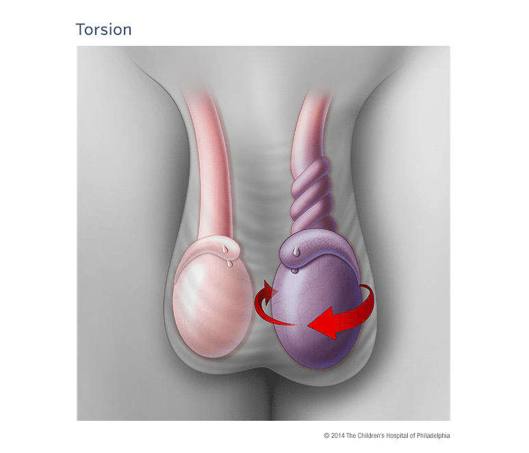 Torsion Cartoon Image