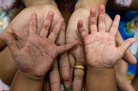 Hand, foot and mouth disease - NHS