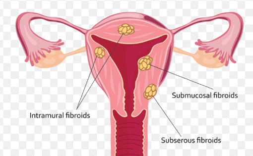 Uterine Fibroids