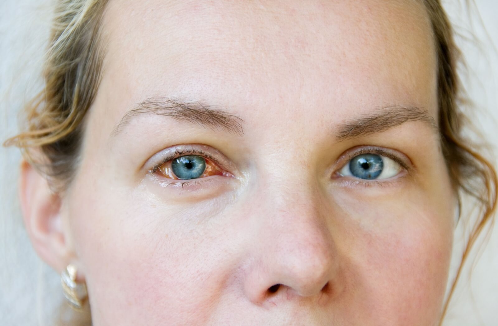 A woman with a watery right eye which is a symptom of glaucoma.