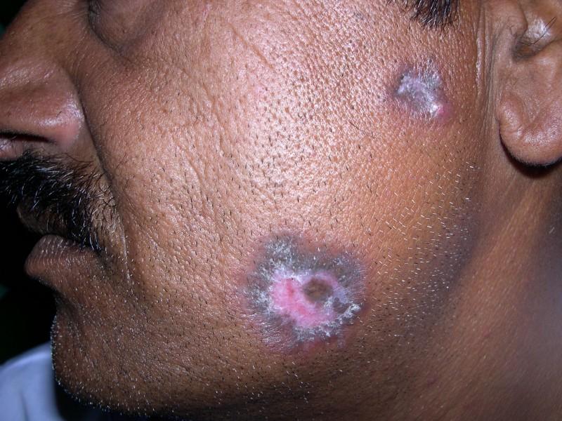 Discoid Lupus Erythematosus