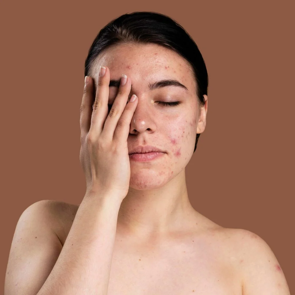 Effective Acne Scar Treatment For Ageless Beauty 5011