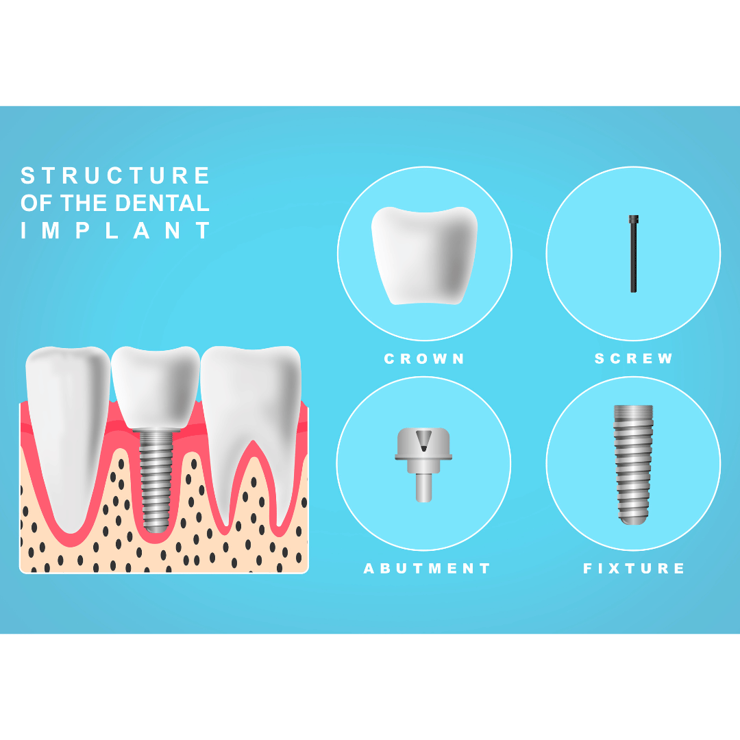 Different Types of Dental Implants