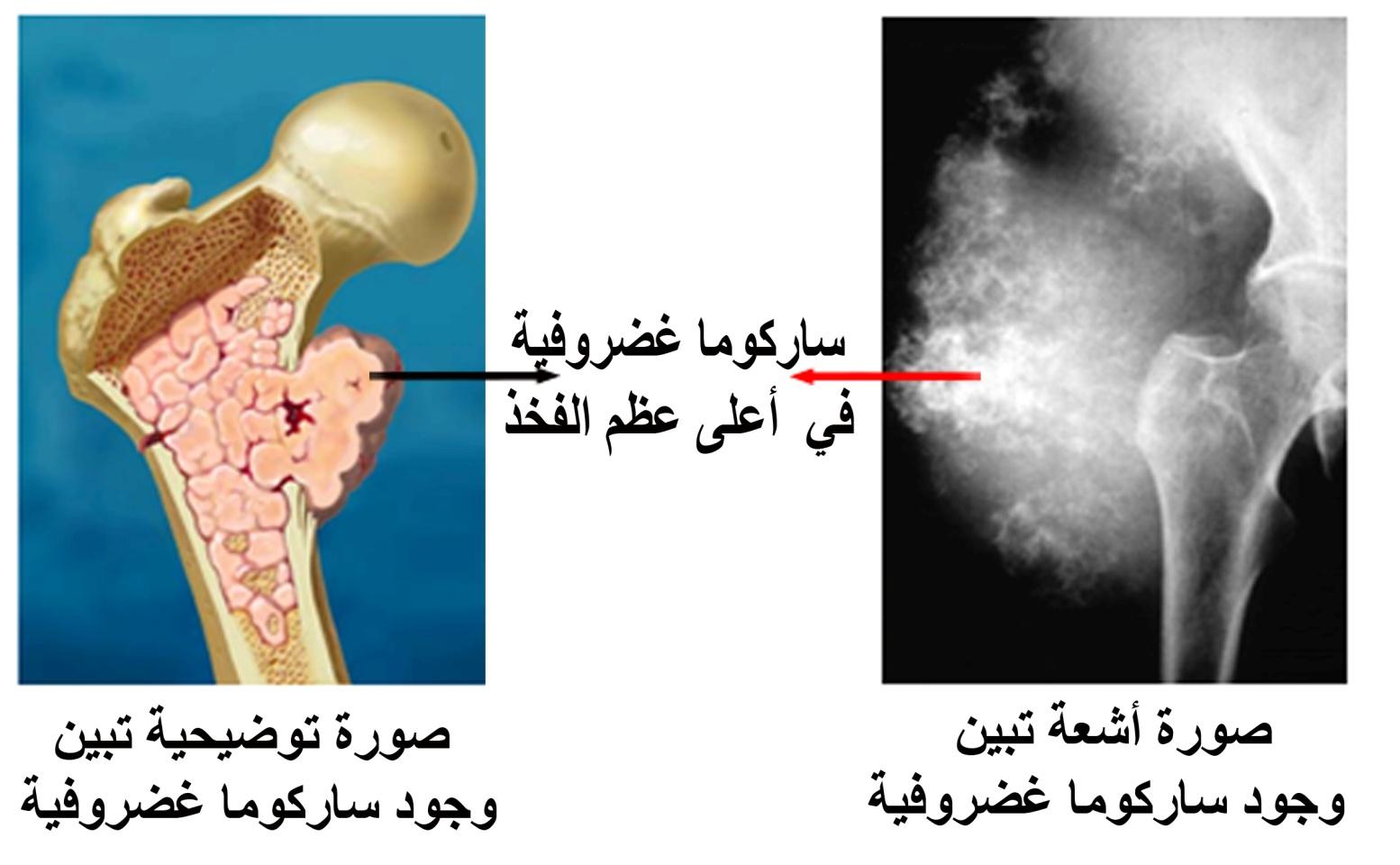 E:\Documents and Settings\USER\Desktop\Shared Files\bone cancer\ساركوما غضروفية.jpg