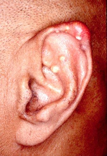 gout ear.jpg