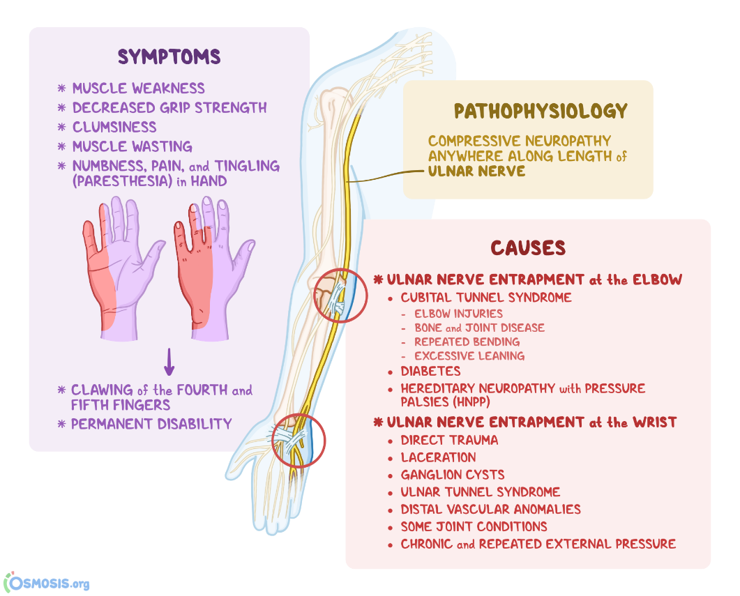 Ulnar Nerve Entrapment: What Is It, Symptoms, Causes, Treatment, and More |  Osmosis