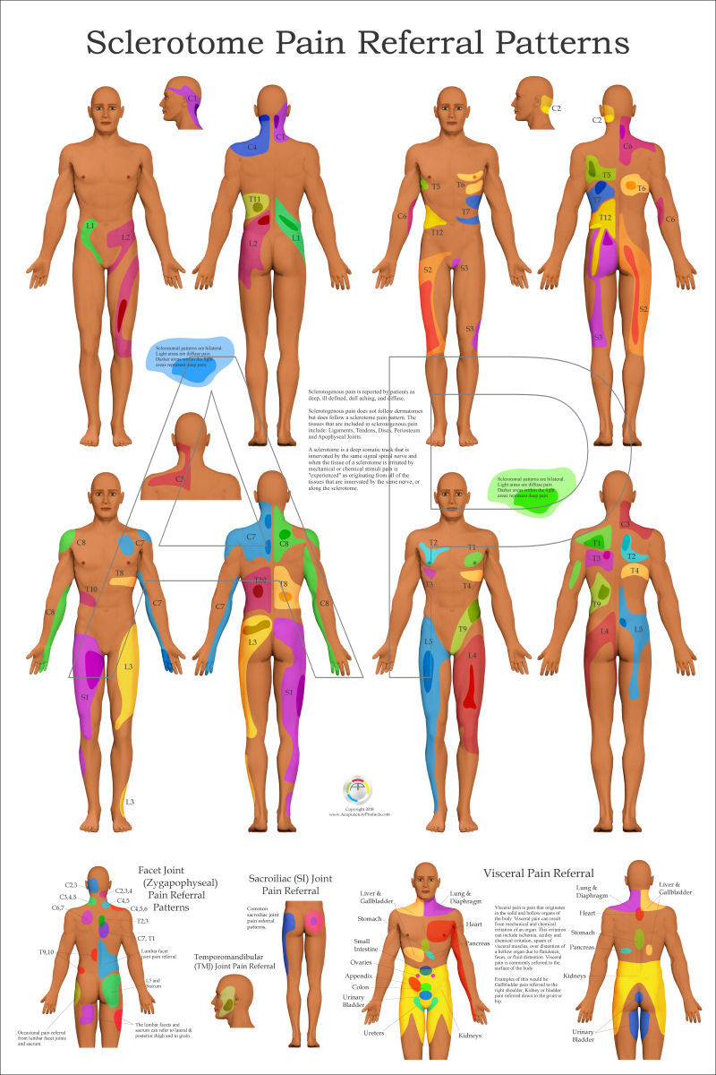 Sclerotomal Pain Pattern