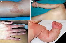 Frontiers | Vascular Birthmarks as a Clue for Complex and Syndromic Vascular  Anomalies