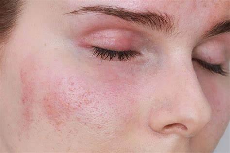 Da nhạy cảm sẽ bị kích ứng đỏ khi sử dụng dòng sữa rửa mặt không phù hợp