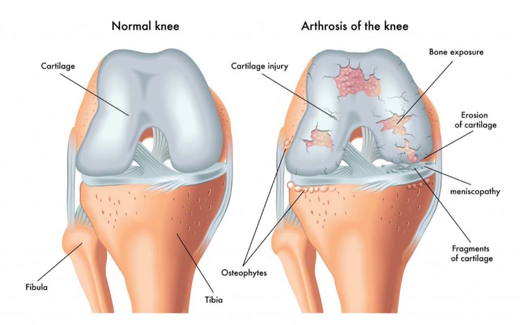 features-of-knee-arthritis