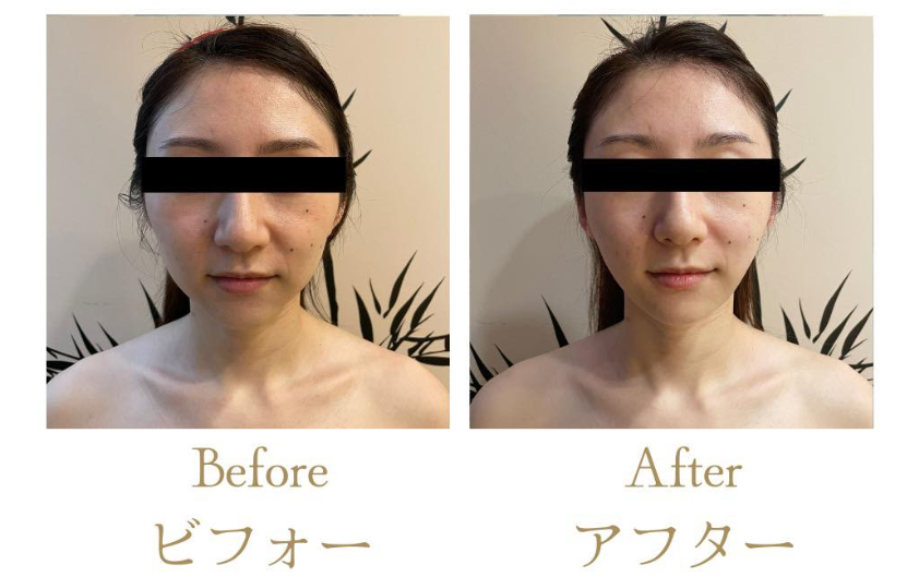 Before and after pictures for small face care