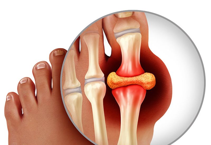 Bệnh Gout - Biến chứng đái tháo đường