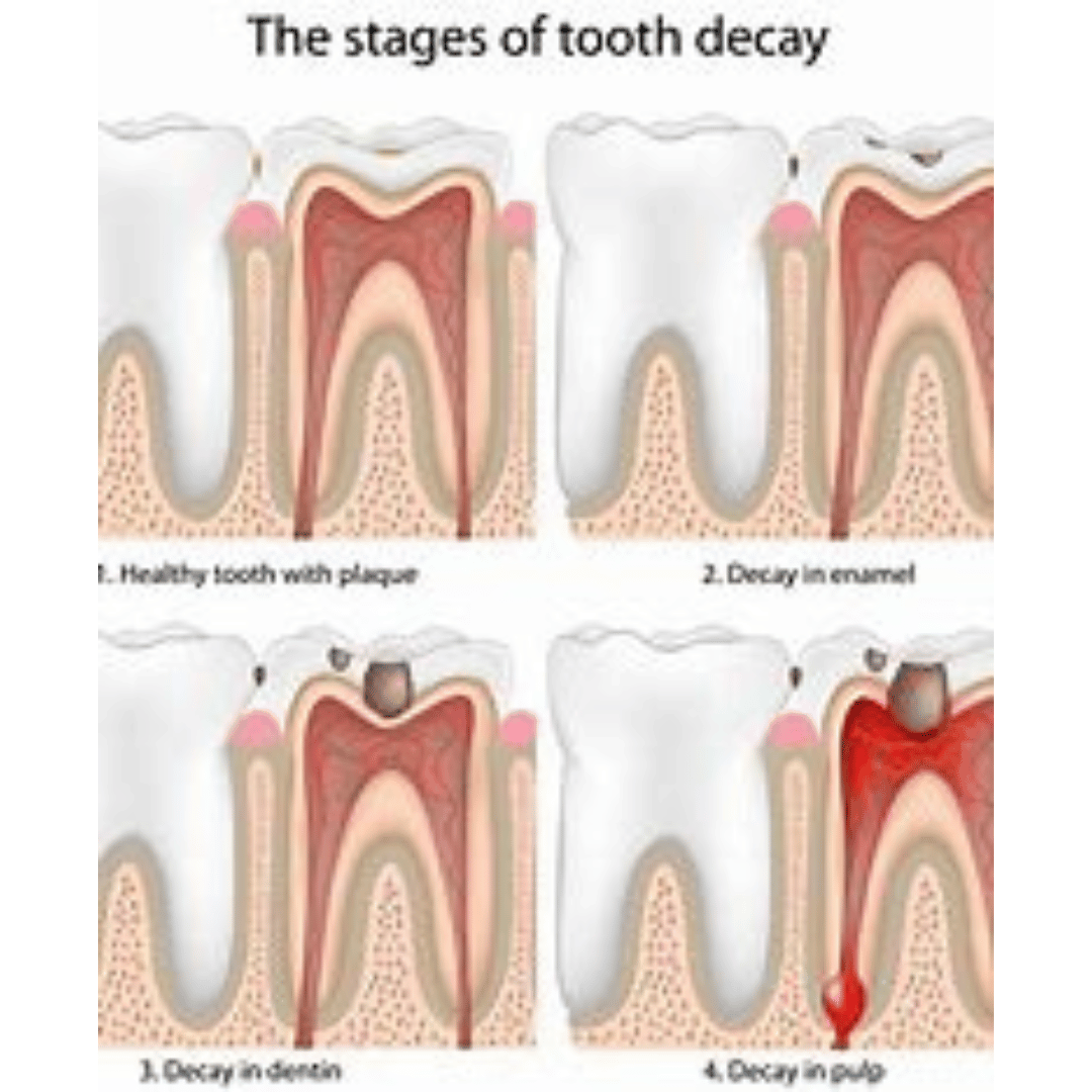 Cavity on Side of Tooth