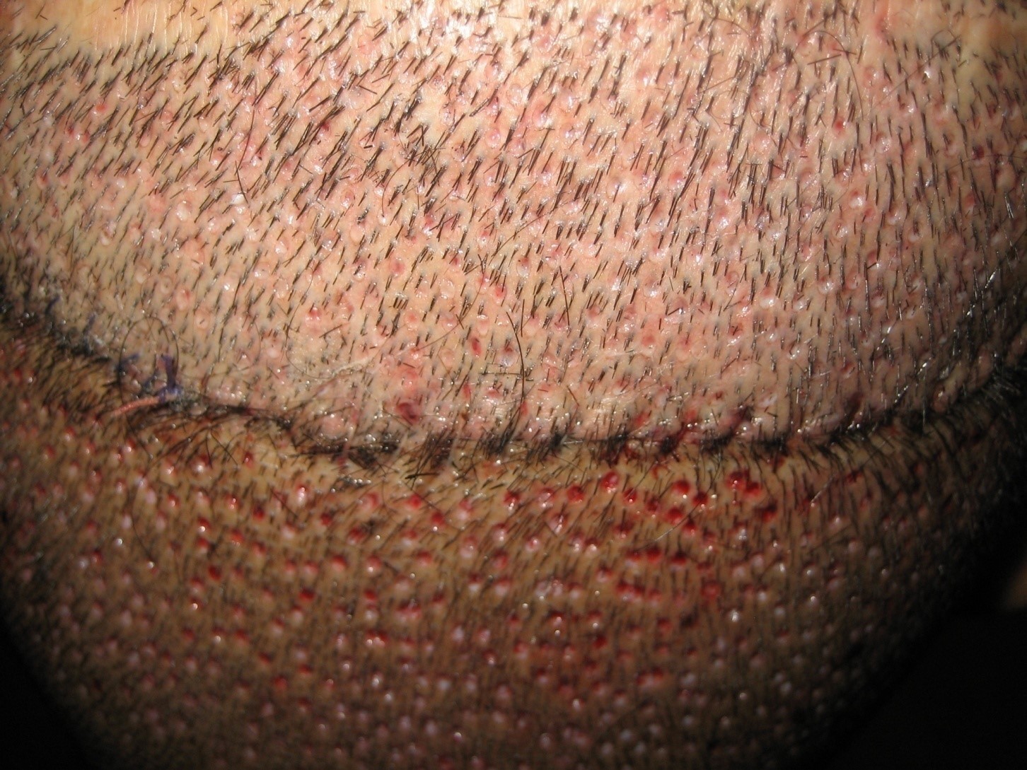 Follicular unit transplantation and follicular unit extraction in the same patient