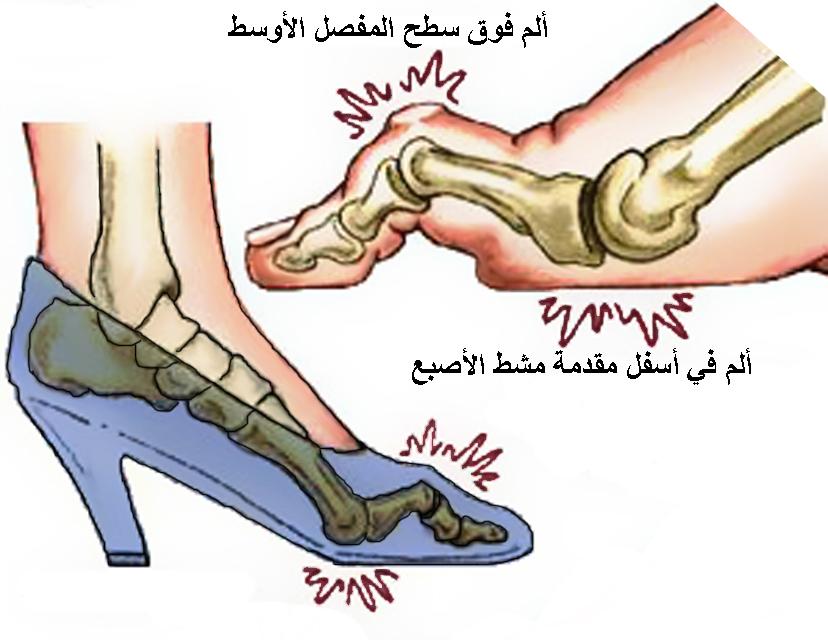 hammer-toes-high-heels.jpg