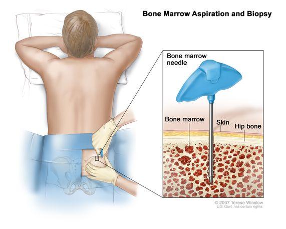 Definition of bone marrow aspiration - NCI Dictionary of Cancer Terms - NCI